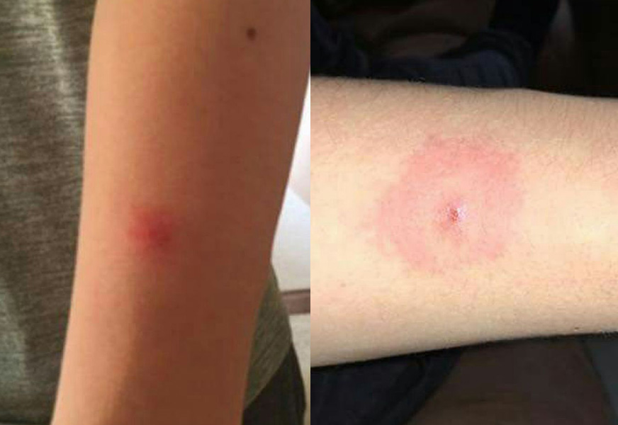 do tick bites itch and hurt and burn do tick bites itch and hurt and burn
